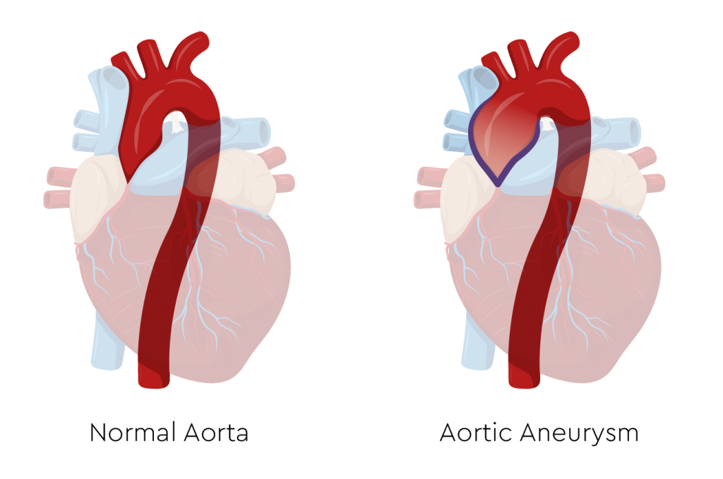 Aorta Basics John Ritter Foundation