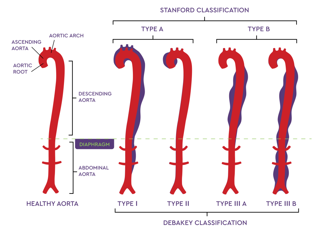 Aorta Basics John Ritter Foundation