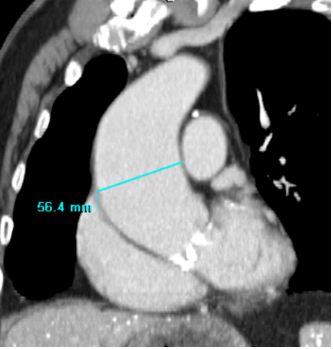 CT angiogram demonstrating an ascending aortic aneurysm that is present in an individual with a bicuspid aortic valve.
From: Braverman AC, Cheng A.  The Bicuspid Aortic Valve and Associated Aortic Disease.  In, Valvular Heart Disease, 5th Edition.  Otto CM, Bonow RO, eds.  A companion to Braunwald’s Heart Disease.  Saunders/Elsevier, Philadelphia, 2020