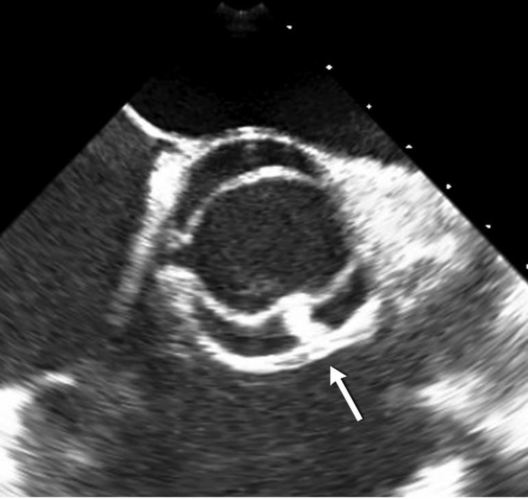 Transesophageal echocardiogram of a bicuspid aortic valve. The valve opening is oval and the arrow points to the raphe, a thickening of the two fused cusps of the valve. From: Braverman AC, Cheng A. The Bicuspid Aortic Valve and Associated Aortic Disease. In, Valvular Heart Disease, 5th Edition. Otto CM, Bonow RO, eds. A companion to Braunwald’s Heart Disease. Saunders/Elsevier, Philadelphia, 2020