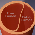 Cross section of the aorta showing the true and false lumen.