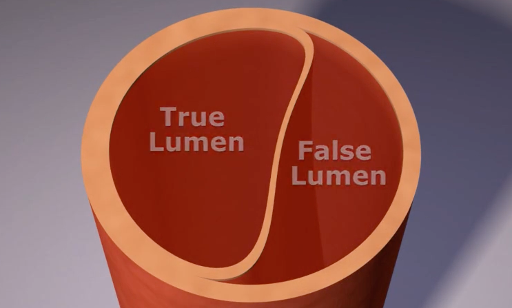 Cross section of the aorta showing the true and false lumen.