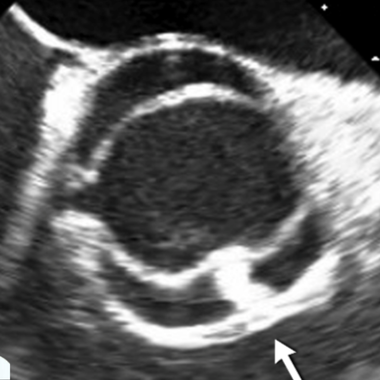 An echocardiogram of a bicuspid aortic valve with Dr. Alan Braverman imposed in front of it.